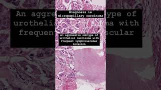 Micropapillary urothelial carcinoma is an aggressive subtype of bladder cancer [upl. by Ogeid372]