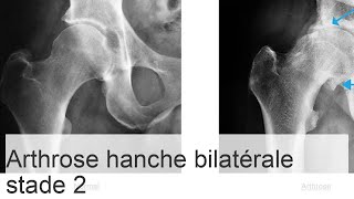 Coxarthrose bilatérale de stade 2  causes symptômes de la maladie méthodes de thérapie [upl. by Acirretal844]