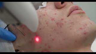 Fotona Laser Acne Treatment No Dialogue [upl. by Hugon941]