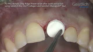 Ridge Preservation after Tooth Extraction  PD PhD Ronald Jung english [upl. by Aillicsirp]