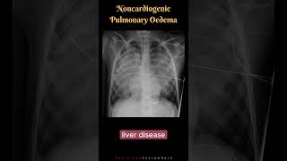 Noncardiogenic Pulmonary Edema Differential Diagnosis shorts radiologyshorts [upl. by Bracci]