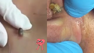 Ultimate Pimple Popping Extravaganza 2024 💥👀 [upl. by Pavia]