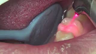 Tooth Restoration  Class 1  Waterlase Laser Dentistry Restorative Dentistry [upl. by Trepur]