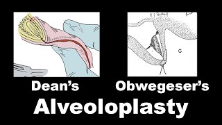 Deans Alveoloplasty amp Obwegeser Alveoloplasty [upl. by Ann]