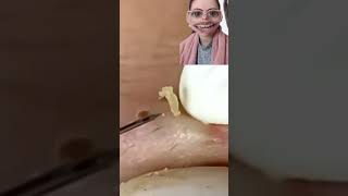 Blackheads Removal  Acne Treatment and Very Satisfying Satisfying Pimple pop blackheads [upl. by Dacey]