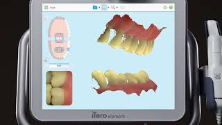 iTero® Scanner Tutorial PreTreatment Scan [upl. by Ellenhoj]