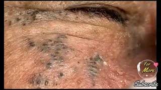 Dr Pop  Deep Blackheads in old Skin removing amp treatment 2020 Part 5 [upl. by Atiuqrahc973]