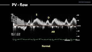 〖Echocardiography〗 Diastolic dysfunction X  Scoring in DD PV signal amp stress test 🚴🏼‍♂️🫀 [upl. by Anitselec]