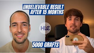 Receding hairline Hair Transplant before and after [upl. by Eseilanna]