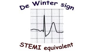 De Winter sign [upl. by Gottuard197]