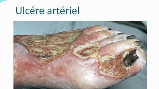 DERMATOLOGIE les ulcéres de jambe [upl. by Ahsaya]