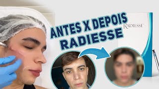 RADIESSE ANTES E DEPOIS [upl. by Noicnecsa]