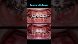 Fix an overbite with braces braces orthodontist dentist niengrang [upl. by Nylteak]