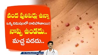 A solution to Remove Warts  Warts on Face and Neck  Pulipirlu  Dr Ravikanth Kongara [upl. by Ahsilrae]