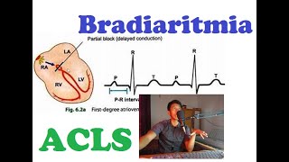 Belajar ACLS Bradiaritmia Sinus Bradikardi AV block Mobitz 1 Mobitz 2 UKDI UKMPPD [upl. by Navinod]