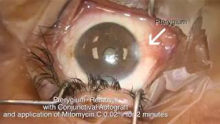 Pterygium removal with conjunctival autograft and mitomycin C Shannon Wong MD 52817 [upl. by Akemej]