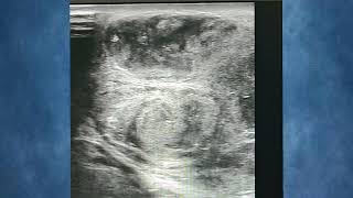 Testicular Abscess Complicated EpididymoOrchitis infection medical health ultrasound trending [upl. by Katz]