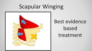 Scapular Winging Causes and Treatment [upl. by Notfol]