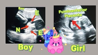 22 wk Fetal heartbeat anomaly ultrasound  Fundal Anterior placenta means baby boygirl  pregnancy [upl. by Amsirhc767]