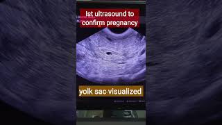 1st ultrasound to confirm pregnancy Gestational sac kya hota hai [upl. by Piane339]