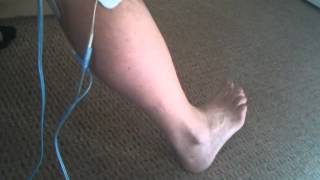 Peroneal Nerve Stimulation with Globus [upl. by Oidivo]