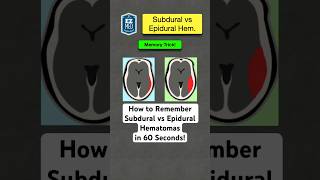 🔥 How to Remember Subdural vs Epidural Hematomas in 60 Seconds Nursing [upl. by Hughmanick]