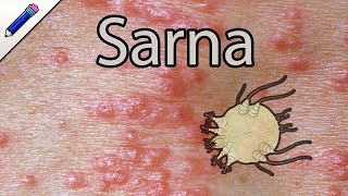 Sarna Humana Escabiosis ¿Cómo saber si tengo Sarna Síntomas Tratamiento Cura [upl. by Selrac398]