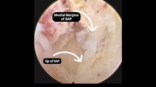 L4L5 interlaminar Endoscopic Decompression Contralateral over the top decompression [upl. by Signe586]