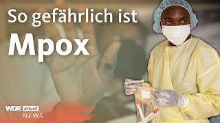 Mpox WHO ruft weltweite Notlage aus  WDR Aktuelle Stunde [upl. by Hera]