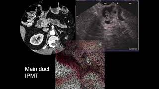 Imaging of Pancreatic Cystic Lesions [upl. by Reklaw645]