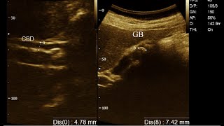 Calculus Cholecystitis  Biliary tree is mild dilated  Amader hospital  Ultrasonography report [upl. by Trauts825]