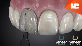 Uveneer® Procedure Animation  Direct Veneer Template System [upl. by Selin]