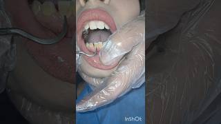 تنظيف جير الاسنان  الطريقة اليدوية dentist اسنان العنايه stitch اكسبلور تسوسالاسنان [upl. by Ellenahs126]