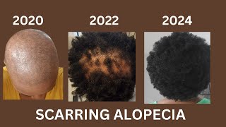 The Secret Solution for Hair Growth with Scarring Alopecia [upl. by Hayidan]