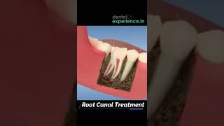 Root Canal Treatment Cost in Kochi Kerala [upl. by Eidoc]