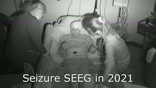 Seizure Clips of Epilepsy Progression [upl. by Reinertson526]