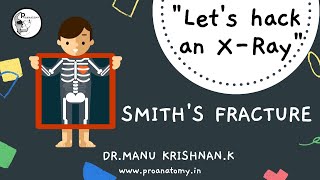 Smiths fracture Lets Hack an XRay series radiological anatomy [upl. by Melburn734]