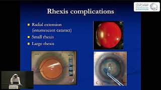 Complications of Cataract Surgery [upl. by Amati]