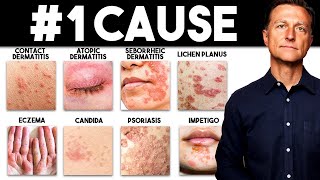 The MOST Common Deficiency in All Skin Diseases Dermatitis [upl. by Seravat]