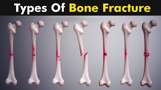 Common types of Bone fracture  3D animation [upl. by Willock]