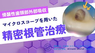 精密根管治療 【愛知県刈谷市の歯医者】 侵襲性歯頸部外部吸収 Invasive Cervical Resorption MTAセメント ラバーダム防湿 マイクロスコープ Kariya city [upl. by Goodhen]