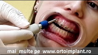 Mini implantul ortodontic  Doare  Cum se pune [upl. by Crofoot]