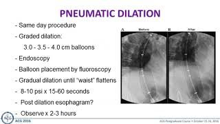 Achalasia Inject Dilate or Surgery [upl. by Drice232]