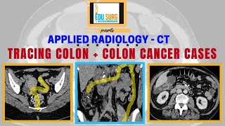 How to read CT scan abdomen  Colon appendix [upl. by Flossi]