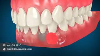 Gum Grafting Surgery  Dental Animation [upl. by Alleynad]