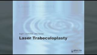 Laser Trabeculoplasty for Glaucoma [upl. by Cima]