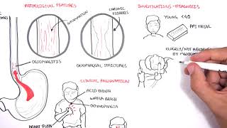 GORD GERD Gastro Oesophageal Reflux Disease  Overview pathophysiology treatment [upl. by Cusack]