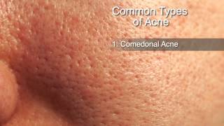 How to Treat Different Types of Acne [upl. by Aicilet]