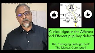 Clinical Signs in Afferent and Efferent pupillary defects  The Marcus Gun Swinging Flashlight test [upl. by Diantha]