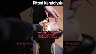 How To Get Rid of Pitted Keratolysis ONCE amp FOR ALL [upl. by Hatty802]